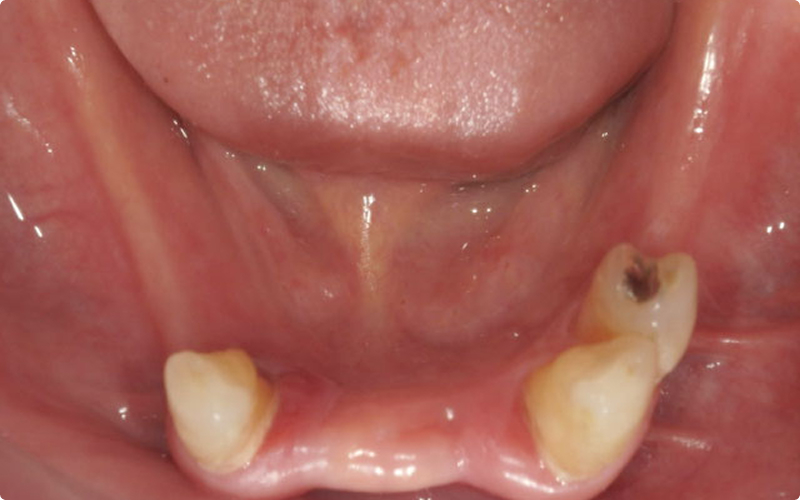 バルプラスト義歯多数歯欠損 before